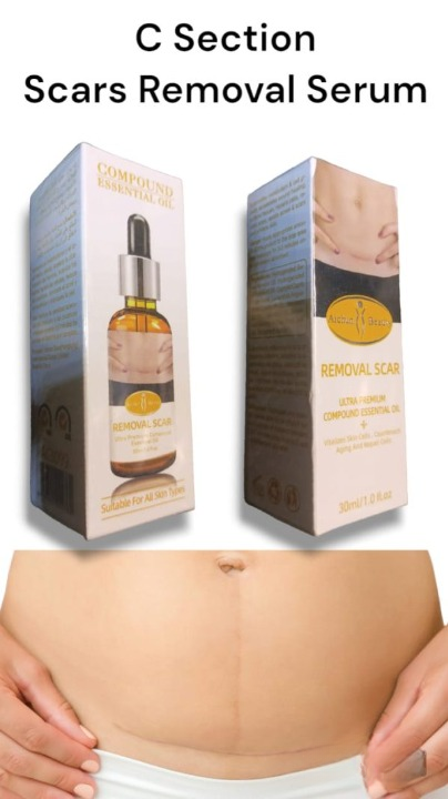 Acne Scar Removal Rejuvenation Serum | Scar, C Section & Stretch Mark Removal Oil For Women